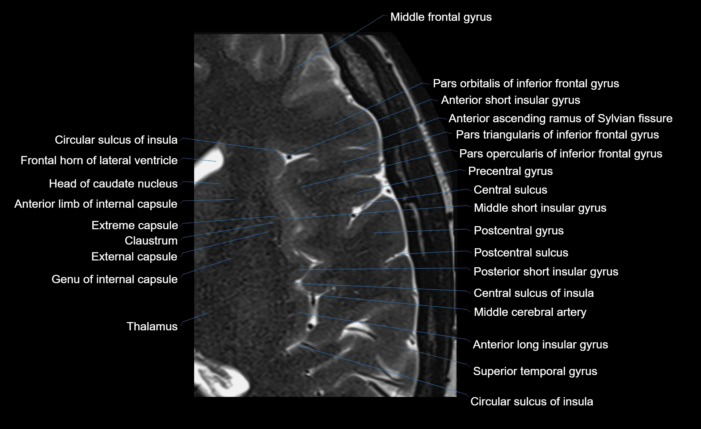 Brain insula axial  anatomy 3T MRI image-img-00001-00015.webp